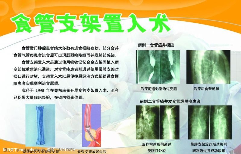 疗程食管支架植入术图片